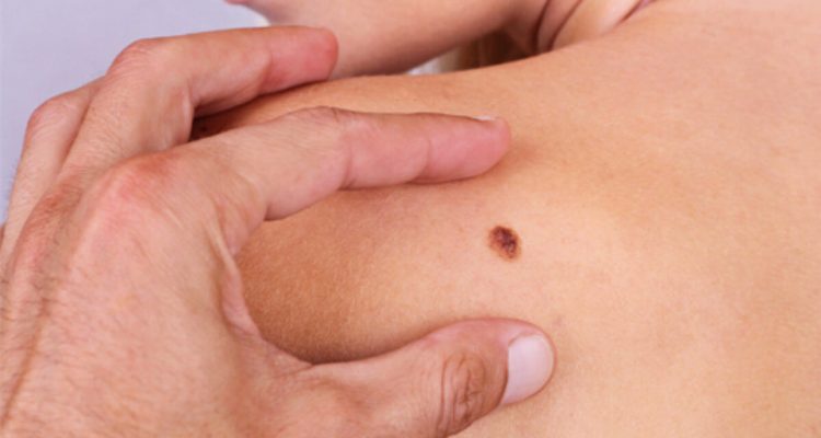 Признаки рака кожи: когда родинка меняется